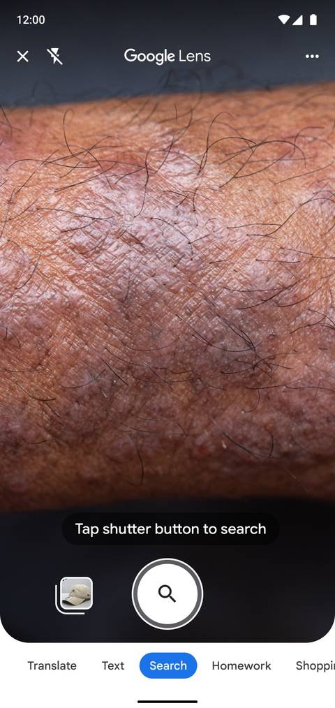 Google Lens can tell you what skin condition you have
