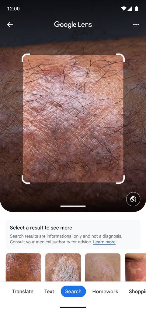 Google Lens can tell you what skin condition you have